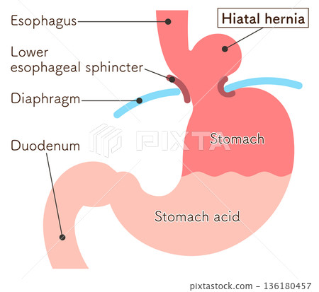 Hiatal hernia illustration Hiatal hernia illustration 136180457