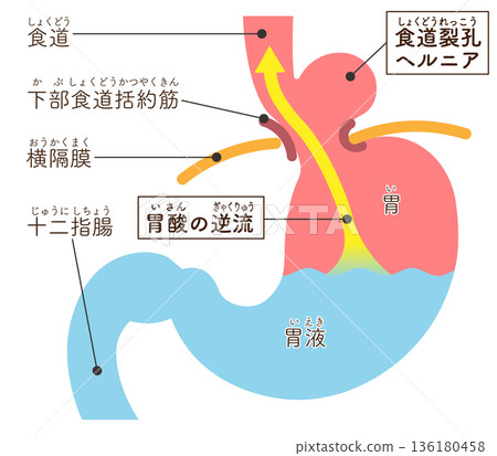 食道裂孔疝氣示意圖 食道裂孔疝氣示意圖 136180458