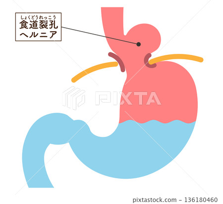 Hiatal hernia illustration Hiatal hernia illustration 136180460