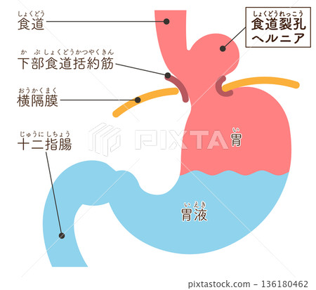 食道裂孔疝氣示意圖 食道裂孔疝氣示意圖 136180462