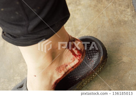 尼泊爾，被山蛭叮咬後出血 136185013