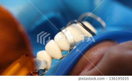 Dental technician carefully working on a patient s teeth during a routine checkup in a bright clinic setting 136195035