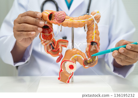 Colorectal cancer, doctor holding intestine colon human anatomy model. 136195232