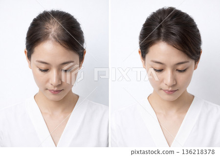 Before and after images of Japanese women's thinning hair and parting concerns. Comparison of hair growth and regrowth effects. 136218378