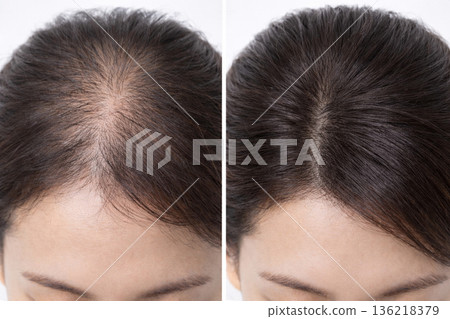 Before and after images of women with thinning hair and parting concerns. A close-up comparison of the effects of hair growth and regrowth. 136218379