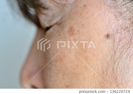 受臉部瑕疵、皺紋、雀斑、痣和疣困擾的老年女性 136220729