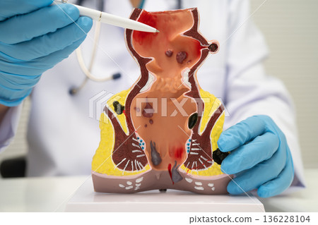 Asian doctor with rectum and hemorrhoid human anatomy model at hospital, inflamed vascular structure. 136228104