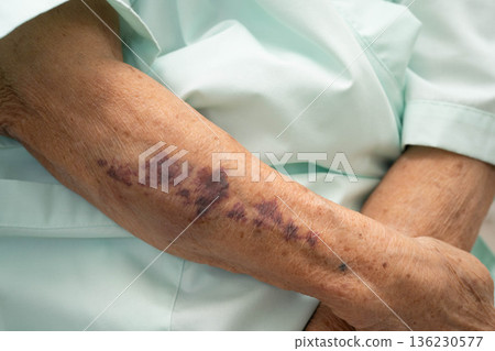 Ecchymosis, elderly bleeding on her arm after taking aspirin. Ecchymosis, elderly bleeding on her arm after taking aspirin. 136230577