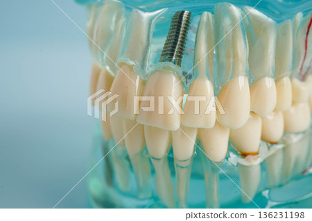 Dental implant, artificial tooth roots into jaw, root canal of dental treatment, gum disease, teeth model for dentist studying about dentistry. Dental implant, artificial tooth roots into jaw, root canal of dental treatment, gum disease, teeth model for dentist studying about dentistry. 136231198