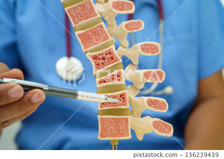 Doctor holding osteoporosis in back bone model for treatment medical in orthopedic department. Doctor holding osteoporosis in back bone model for treatment medical in orthopedic department. 136239439