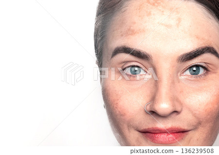 Caucasian woman shows face with pigmentation, melasma, freckles, age spots photo close up on white copy space 136239508