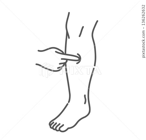 Illustration of checking for swelling (edema) and indentations in the legs (diabetic nephropathy and heart failure) Illustration of checking for swelling (edema) and indentations in the legs (diabetic nephropathy and heart failure) 136262632