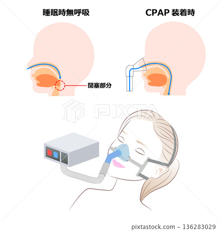 Continuous positive airway pressure (COAP) during sleep Continuous positive airway pressure (COAP) during sleep 136283029