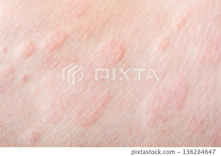 Skin allergy rash dermatitis texture close up background Skin allergy rash dermatitis texture close up background 136284647