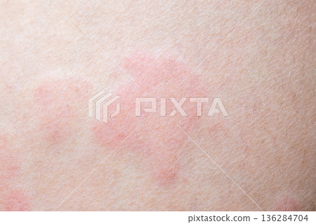 Skin allergy rash dermatitis texture close up Skin allergy rash dermatitis texture close up 136284704