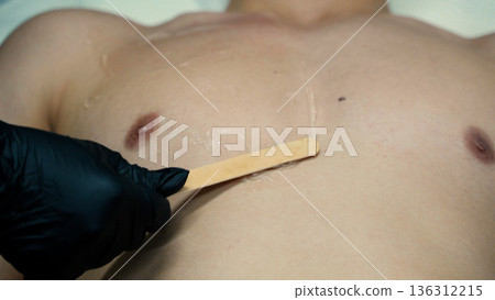 Close up of laser hair removal on male chest Close up of laser hair removal on male chest 136312215