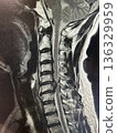 Cervical hernia 136329959
