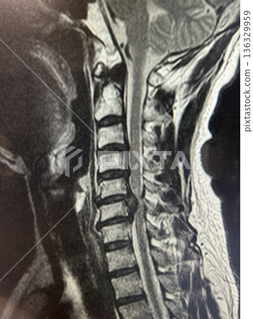 頸椎疝 136329959