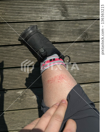 Hiking leg skin irritation close up on wooden boardwalk, pilgrim showing rash during Camino de Santiago. Health awareness, outdoor safety education, long distance hiking challenges, travel preparation Hiking leg skin irritation close up on wooden boardwalk, pilgrim showing rash during Camino de Santiago. Health awareness, outdoor safety education, long distance hiking challenges, travel preparation 136363215