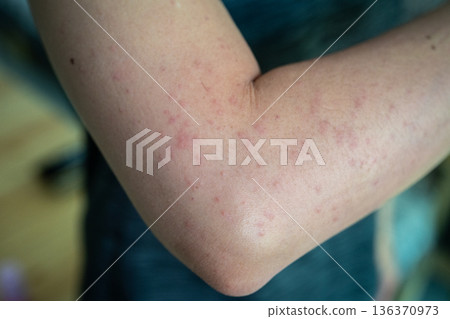 Cropped shot view of rashes occur on woman arm. A rash on your arms can occur due to an allergic reaction, contact with irritants, infection, or an underlying medical condition like psoriasis. Cropped shot view of rashes occur on woman arm. A rash on your arms can occur due to an allergic reaction, contact with irritants, infection, or an underlying medical condition like psoriasis. 136370973