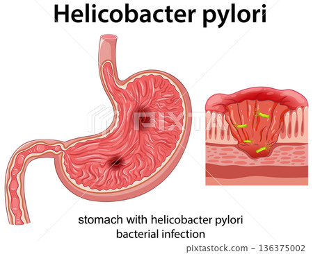 Human Stomach with Helicobacter Pylori Bacterial Infection Illustration 136375002