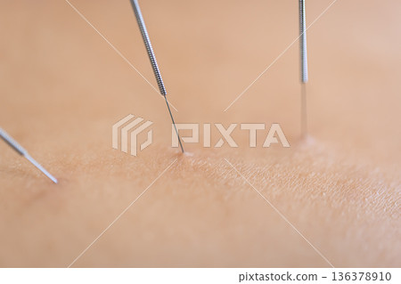 Dry needling acupuncture needles on patient, close up. 136378910