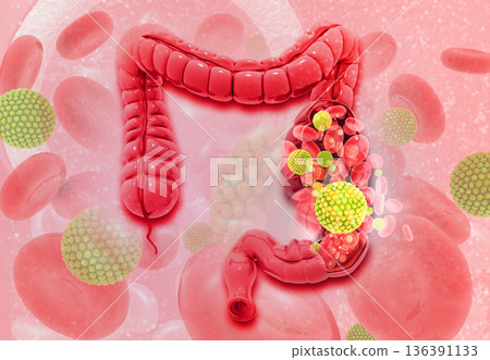 Colon cancer 136391133