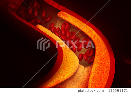 Cholesterol blocking artery Cholesterol blocking artery 136391171