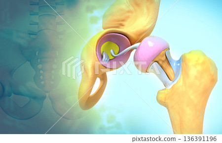Hip replacement in the pelvis bone Hip replacement in the pelvis bone 136391196