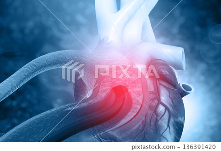 Human heart angioplasty Human heart angioplasty 136391420