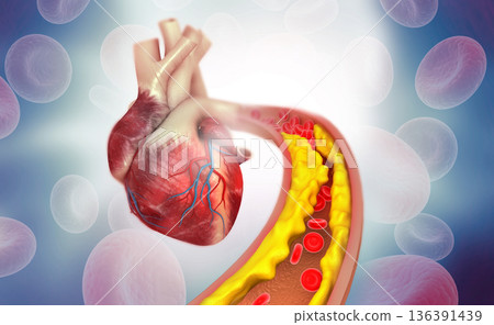 Cholesterol plaque in artery with Human heart anatomy Cholesterol plaque in artery with Human heart anatomy 136391439