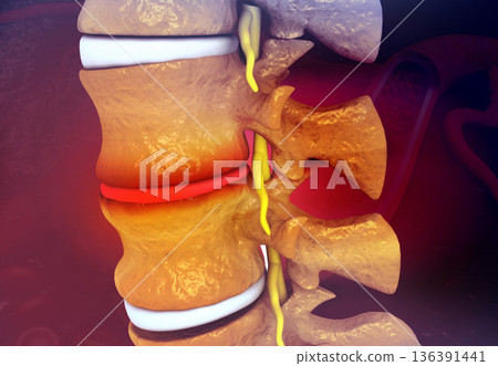 Human Spine With Slipped Disc 136391441