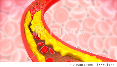 Artery blocked with bad cholesterol 136391472