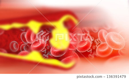 Artery blocked with bad cholesterol 136391479