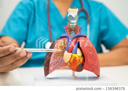 Pneumonia, lung cancer, Asian doctor holding human model. 136396378