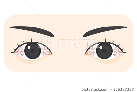 Vector illustration of bloodshot eyes Vector illustration of bloodshot eyes 136397337