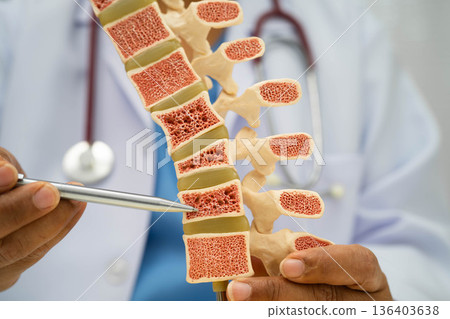 Doctor holding osteoporosis in back bone model for treatment medical in orthopedic department. 136403638