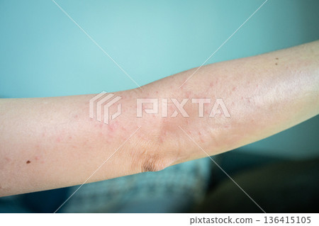 Cropped shot view of rashes occur on woman arm. A rash on your arms can occur due to an allergic reaction, contact with irritants, infection, or an underlying medical condition like psoriasis. Cropped shot view of rashes occur on woman arm. A rash on your arms can occur due to an allergic reaction, contact with irritants, infection, or an underlying medical condition like psoriasis. 136415105