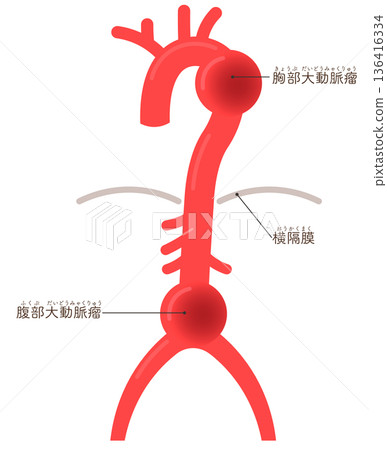 Illustration of an aortic aneurysm 136416334