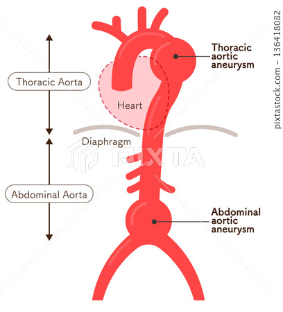 Illustration of an aortic aneurysm 136418082