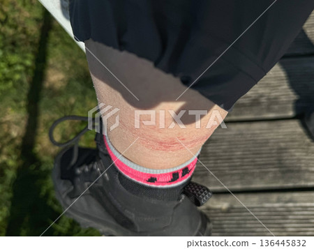 Hiker leg with skin irritation after long walk on Camino de Santiago, sock line, shoe, redness on calf. Health awareness, hiking safety education, outdoor endurance concepts, travel preparation 136445832