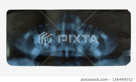 Panoramic dental x ray showing jaw, teeth and orthodontic braces in diagnostic dental x ray image. Medical dental x ray scan used for orthodontics, surgery planning, oral health assessment 136449552