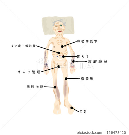 廢用綜合症引起的生理變化：肌肉萎縮、關節攣縮、營養不良和皮膚脆弱的圖示 136478420
