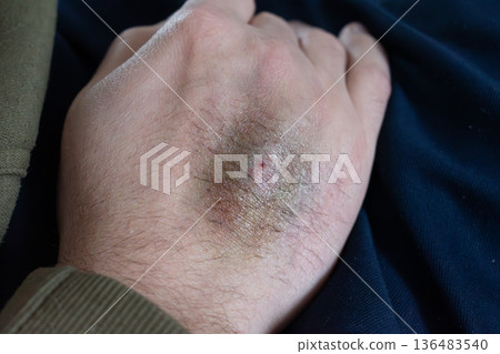 Bruise on arm after blood test, hematoma Bruise on arm after blood test, hematoma 136483540