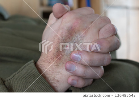 Bruise on arm after blood test, hematoma 136483542