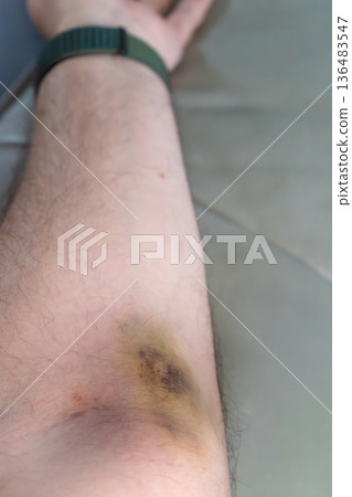 Bruise on arm after blood test, hematoma 136483547