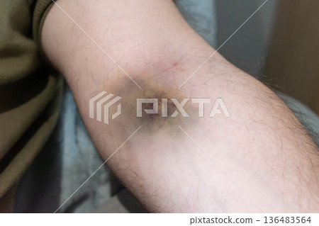 Bruise on arm after blood test, hematoma Bruise on arm after blood test, hematoma 136483564