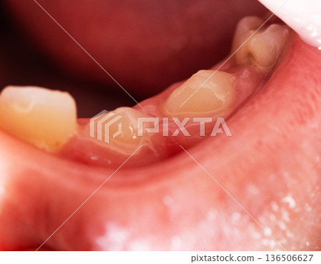 Close-up view of child oral cavity showing permanent teeth erupting behind primary teeth, dental development stage of mixed dentition 136506627