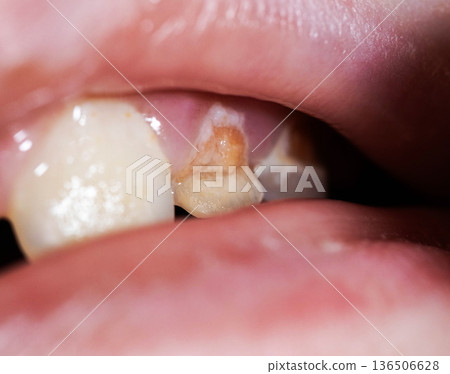 Close up view of damaged milk tooth in child mouth showing enamel hypoplasia and early decay development with visible discoloration 136506628