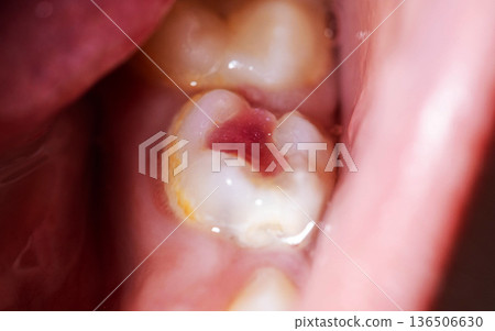 Chipped molar tooth of child with bright red colored dental filling applied, close-up macro view of pediatric dental restoration procedure 136506630